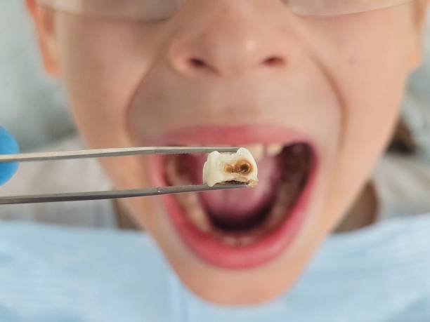 Best Emergency Wisdom Tooth Extraction in Franklin Center, NJ